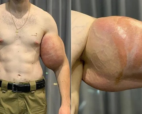 Drsný osud falešného kulturisty. Amputace syntholem napumpovaných paží není vyloučena