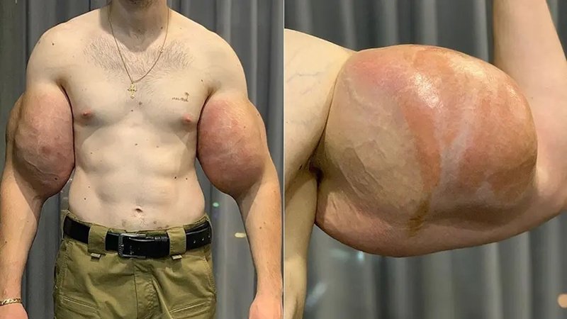 Drsný osud falešného kulturisty. Amputace syntholem napumpovaných paží není vyloučena